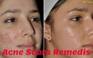 Home Remedies For Acne Scar Removal