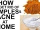 Natural Home Remedies For Acne