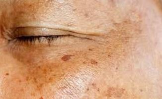 Age Spots