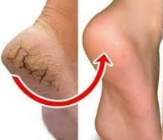 Cracked Heels