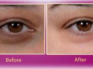 Dark circles under eyes