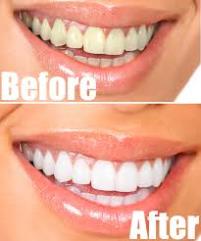 Teeth Whitening