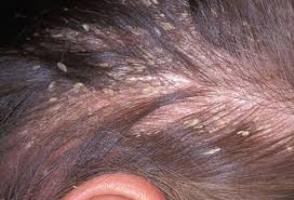 dandruff treatment
