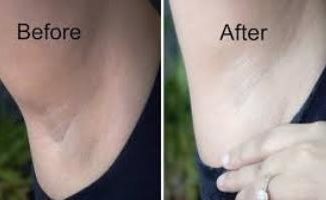 Dark Underarms Treatment