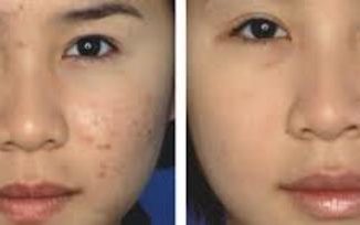 dark spots