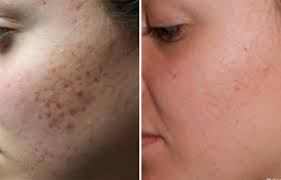Natural Home Remedies For Acne Scar Removal